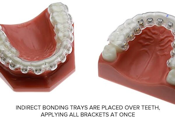 Direct vs. Indirect Bonding: Which is Better?